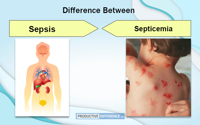 Sepsis and Septicemia