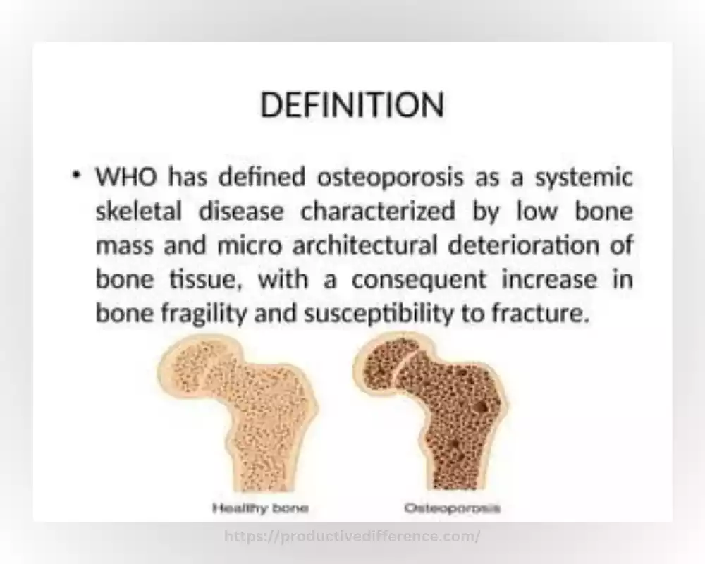 Definition of Osteoporosis