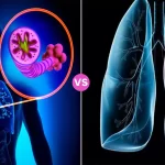 COPD and Lung Cancer