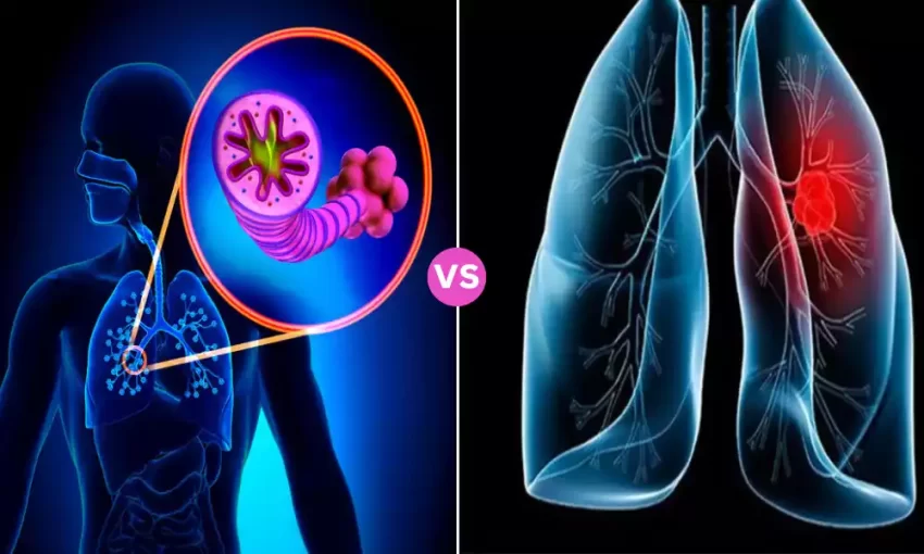 COPD and Lung Cancer