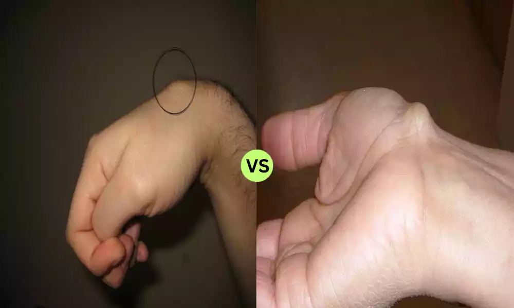 Carpal Boss and Ganglion Cyst