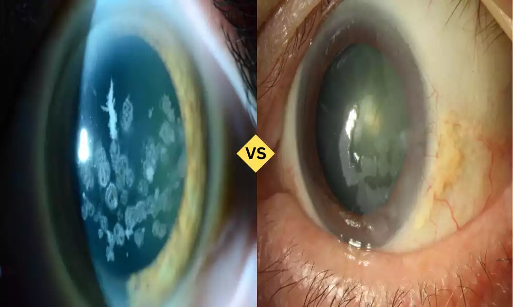 Corneal Dystrophy and Degeneration