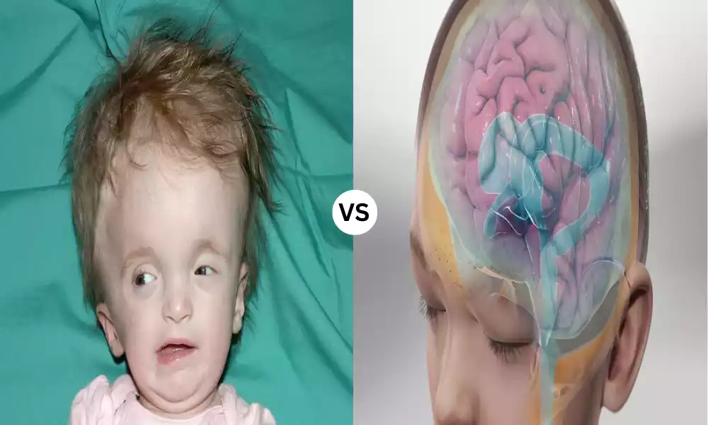 Macrocephaly and Hydrocephalus