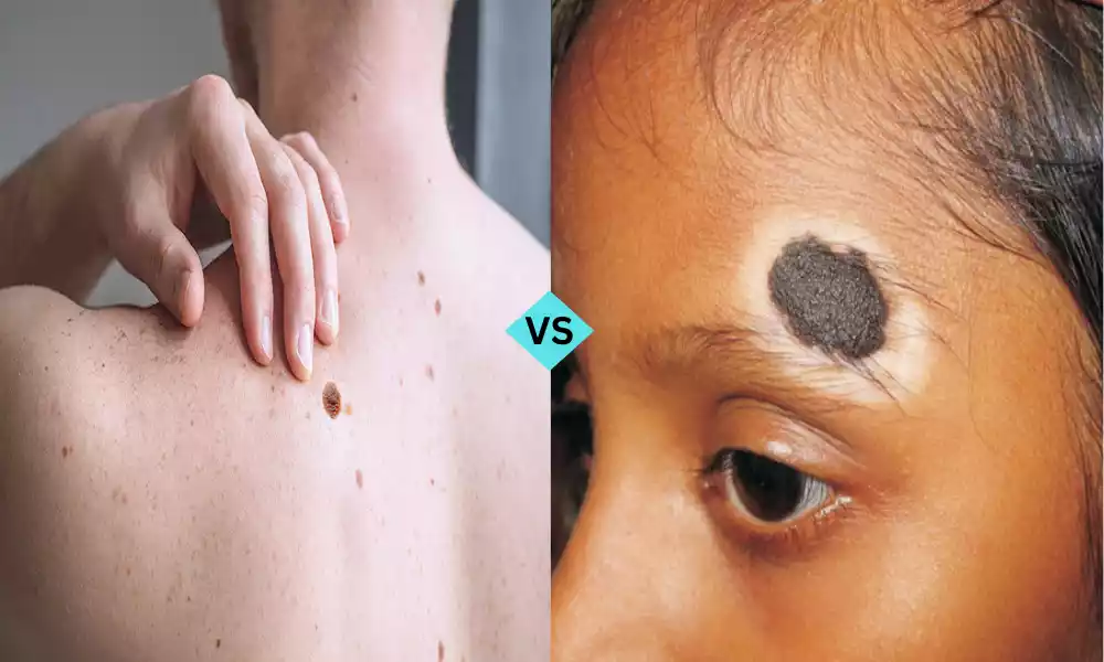 Melanoma and Nevus