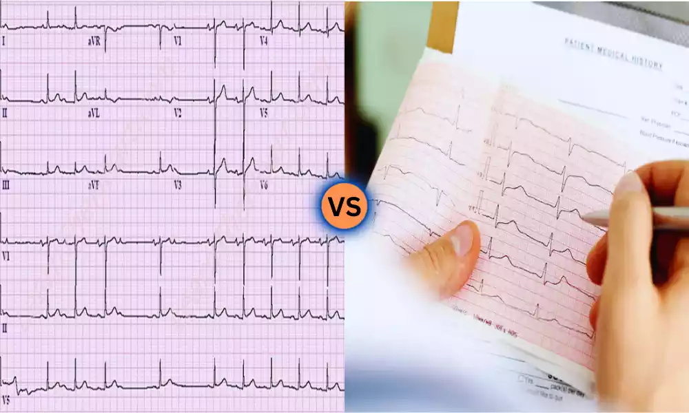 PAC and Sinus Arrhythmia