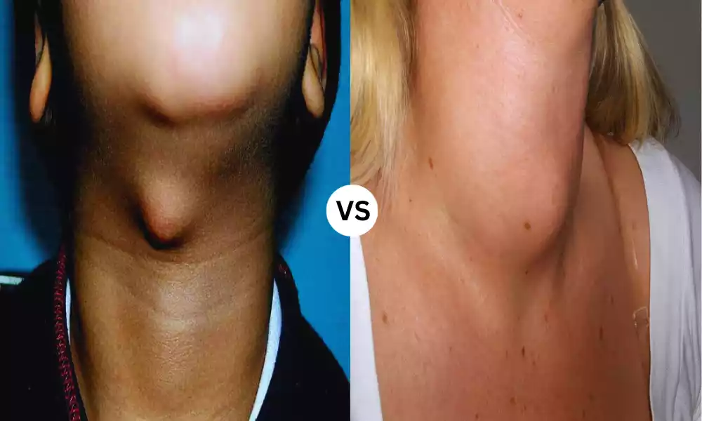 Thyroglossal Cyst and Goitre